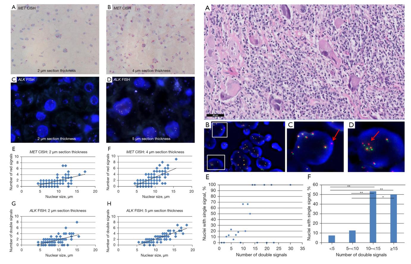 Left: Representative images of ISH signals in liver control tissue containing physiologic polyploidy; Right: Single signals in polysomic tumor cell nuclei, images, and quantification.