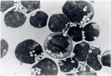 Fig. 1 Photomicrograph of leukemic lymphoblasts from cell line 697 showing prominent vacuolization (× 1000). (Findley HW Jr, et al., 1982)