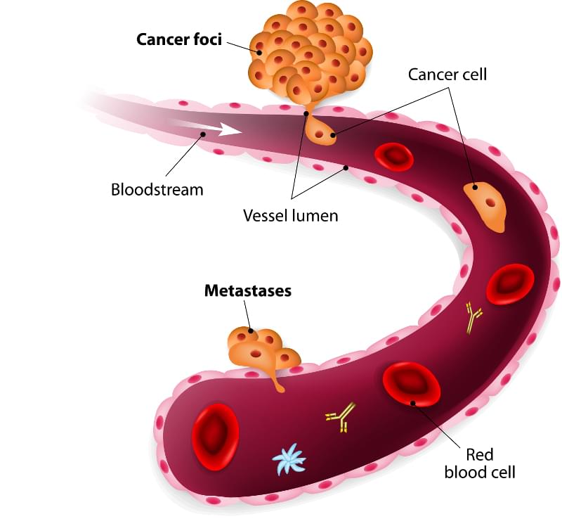 Tumor cells circulate through blood and form a new tumor.