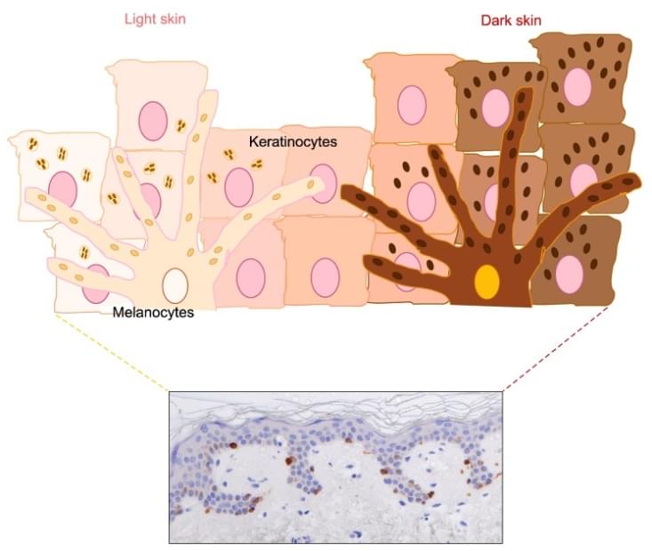 Fontana-Masson stain of melanosomes