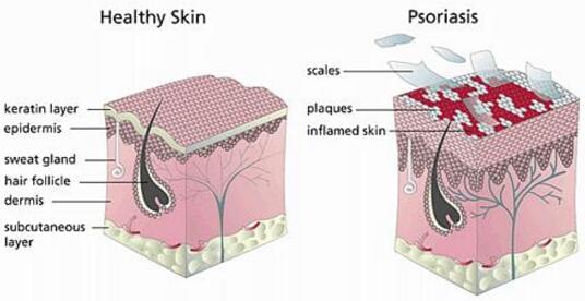 Psoriasis