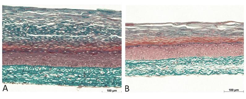 Psoriasis skin Model