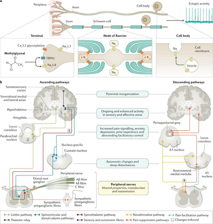 Diagram illustrating the various mechanisms within the central and peripheral nervous systems that play a role in the development of neuropathic pain associated with diabetic neuropathy.