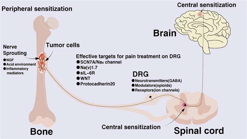Schematic diagram illustrating the mechanisms underlying the development of bone pain caused by cancer.