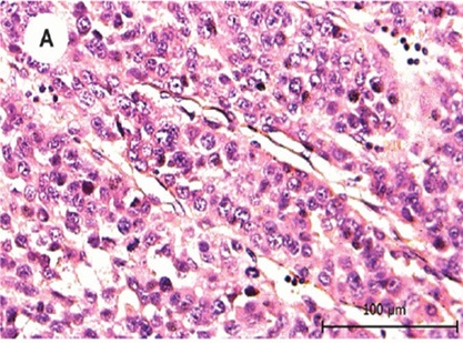 Hematoxylin and eosin staining applied to the patient's primary tumor.