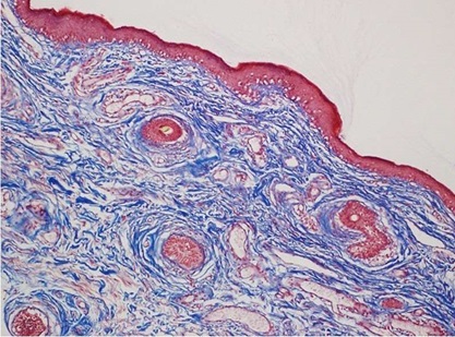 Masson trichrome staining performed on eyelid tissue specimens.