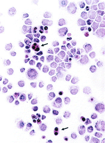 Fig. 1 Morphological features of the MM.1S cultured cells. (Greenstein S, et al., 2003)