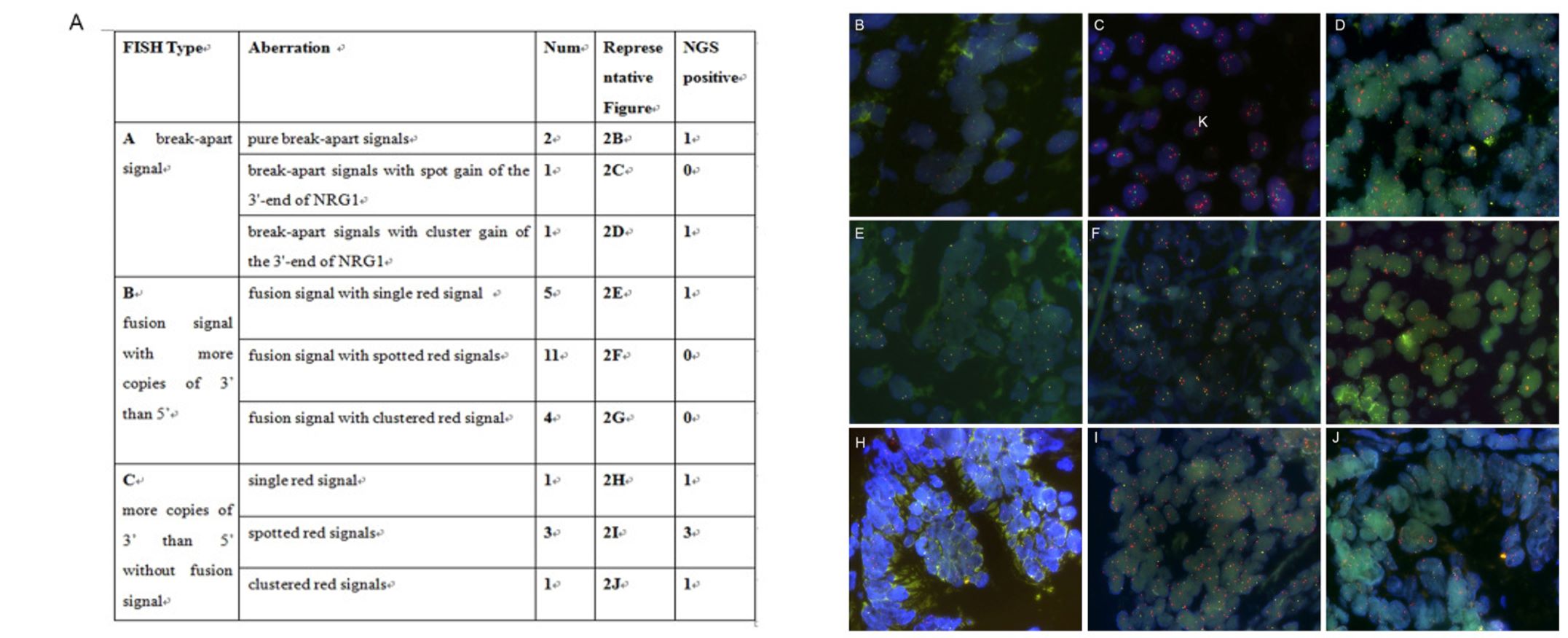 Fig. 1 Distinct FISH signal types of NRG1 aberrations.