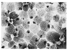 PEER cells showing strongly positive para nuclear stain with acid phosphatase.