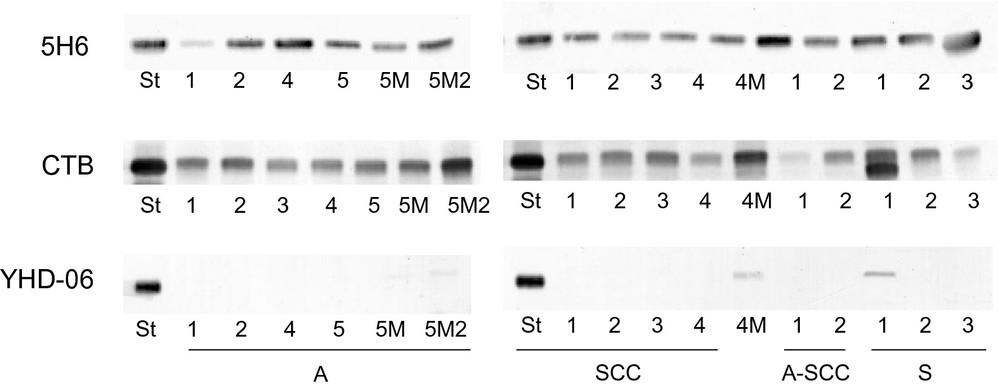 TLC-immunostaining applied anti-GM3 (5H6) antibodies, CTB, and anti-GM2 (YHD-06) antibodies to lipid extracts from tissues of patients afflicted with various types of cervical carcinoma.
