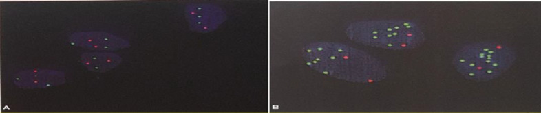 FISH images of an HER 2gene amplified sample using HER 2probes and centromere chromosome 17 (red).