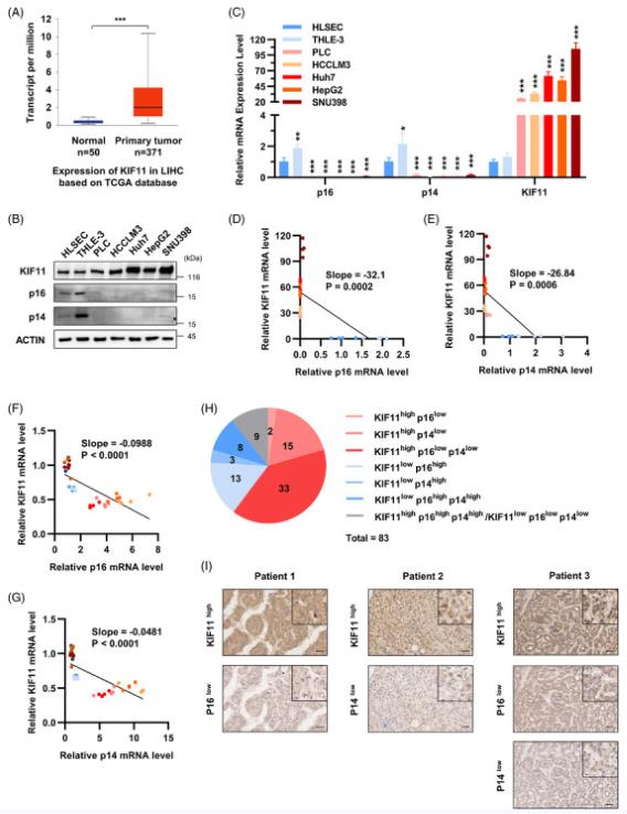 (A) Based on the mRNA expression profile data and clinical information in the TCGA database, KIF11 expression in HCC tissues and associated adjacent tissues were displayed in boxplots. Protein (B) and mRNA (C) levels of KIF11, p16, and p14 in cultured normal liver cells (HLSEC and THLE-3) and hepatoma cells (HCCLM3, Huh7, HepG2, SNU398). (D) Correlation analysis of KIF11 and p16 in cultured normal liver cells (HLSEC and THLE-3) and hepatoma cells (HCCLM3, Huh7, HepG2, SNU398). (E) Correlation analysis of KIF11 and p14 in cultured normal liver cells (HLSEC and THLE-3) and hepatoma cells (HCCLM3, Huh7, HepG2, SNU398). (F) Correlation analysis of KIF11 and p16 in ROS stress-induced normal liver cells (THLE-3) and hepatoma cells (Huh7 and HepG2). (G) Correlation analysis of KIF11 and p14 in ROS stress-induced normal liver cells (THLE-3) and hepatoma cells (Huh7 and HepG2). (H) Pie chart of different expression levels of KIF11, p16, and p14 in clinical HCC tissues. (I) IHC pictures of KIF11high p16low expression in patient 1, IHC pictures of KIF11high p14low expression in patient 2, and KIF11high p16low p14low expression in patient 3.