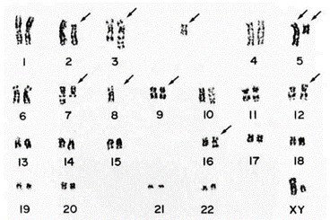 Representative karyotype of Kasumi-3 cells include 46, XY, t(2;5)(p13;q33), t(3;7)(q27;q22), del(5)(q15), -8, del(9) (q32), add(12)(p11), add(16)(q13), +mar.