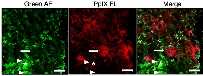 Representative fluorescence microscopy showing cancer cell-specific localization of ALA-induced PpIX.