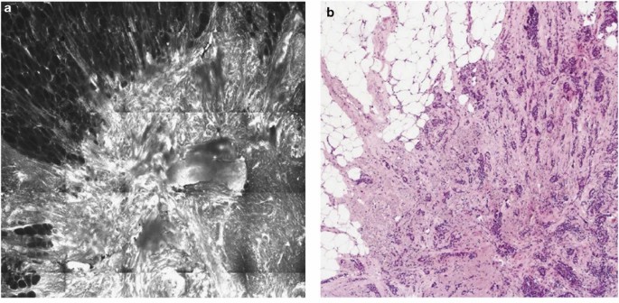 Fluorescence confocal microscopy used for examining invasive breast carcinoma.