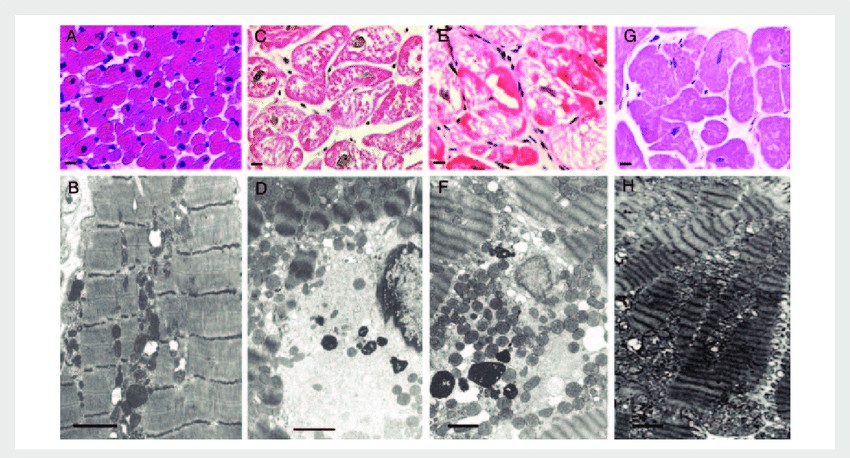 Histological examination and transmission electron microscopy (TEM) analysis of cardiomyopathy.