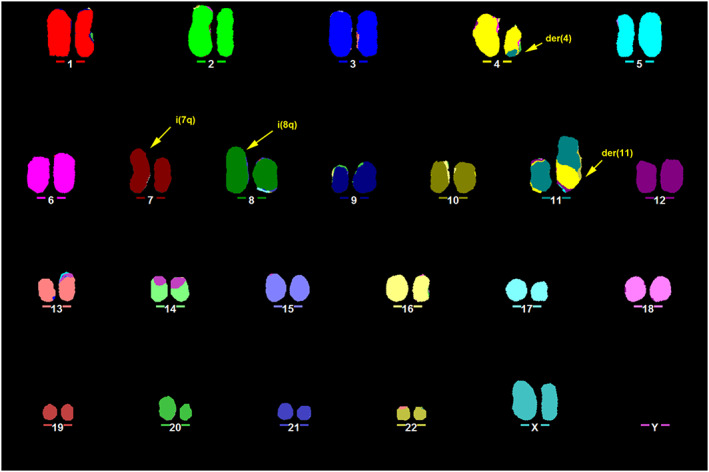 Fig. 1 Representative karyotype of RS4;11 obtained by M-FISH. (Ragusa D, et al., 2019)