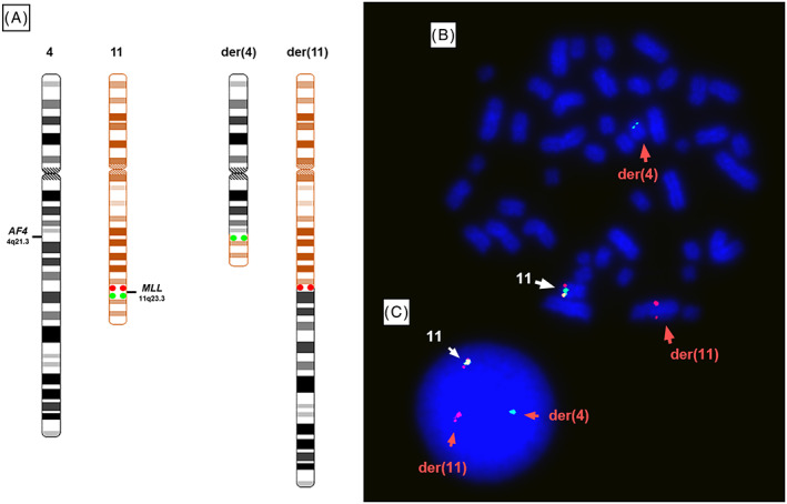 Fig. 3 Dual-colour FISH shows the KMT2A rearrangement in RS4;11. (Ragusa D, et al., 2019)