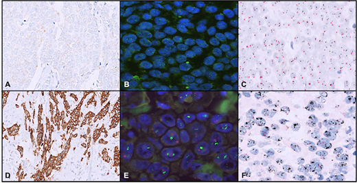 A case with HER2/neu immunohistochemistry (IHC) score 1+ (A), nonamplified on both fluorescence in situ hybridization (FISH) (B) and dual-color dual in situ hybridization (D-DISH) (C). A case with HER2/neu IHC score 3+ (D), amplified on both FISH (E) and D-DISH (F) (original magnifications ×400 [A and D], ×1000 [B and E], and ×600 [C and F]).