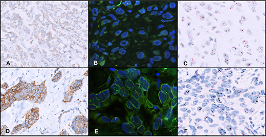 A case with HER2/neu immunohistochemistry (IHC) score 2+ (A), nonamplified on both fluorescence in situ hybridization (FISH) (B) and dual-color dual in situ hybridization (D-DISH) (C). A case with HER2/neu IHC score 3+ (D), amplified on both FISH (E) and D-DISH (F) (original magnifications ×400 [A and D], ×1000 [B and E], and ×600 [C and F]).