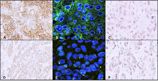 A discrepant case with HER2/neu immunohistochemistry (IHC) score 3+ (A), amplified on fluorescence in situ hybridization (FISH) (B) but nonamplified on dual-color dual in situ hybridization (D-DISH) (C). Another discrepant case with HER2/neu IHC score 2+ with heterogeneity (D), amplified on FISH (E) but nonamplified with intermixed heterogeneity and focal black dust on D-DISH (F) (original magnifications ×400 [A and D], ×1000 [B and E], and ×600 [C and F]).