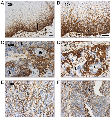 (A) Representative IHC analyses of CD44 in normal esophageal tissues. (B) Magnification of (A) demonstrated that the expression of CD44 was in the basal layer (indicated by arrow). (C–F) Representative IHC analyses of CD44 in ESCC tissues. (C–D) showed specimens with strong expression of CD44 and (E–F) showed cases with weak expression of CD44.