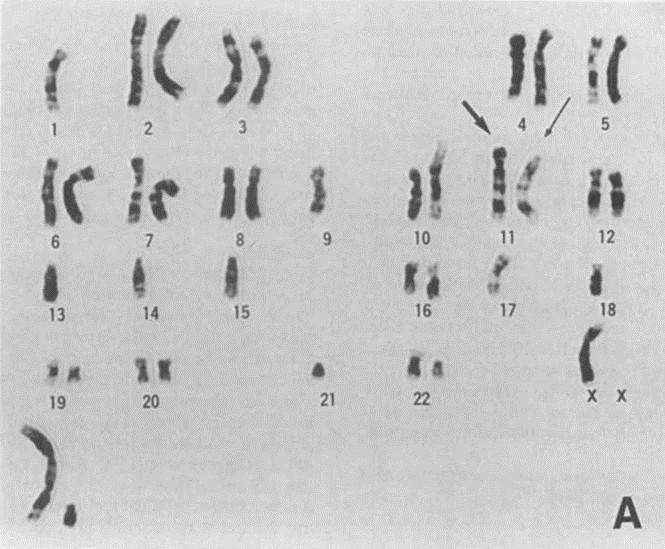 Representative G-banded karyotypes of KMS-12-PE cells. (Ohtsuki T, et al., 1989)