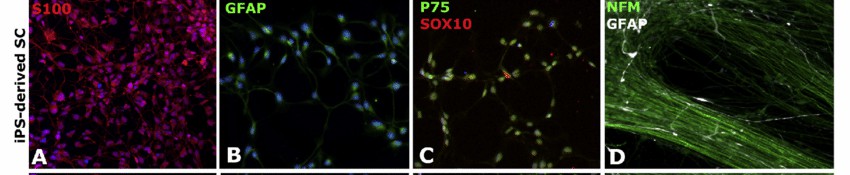 Human iPSC-derived Schwann cells were stained in a 2D environment using specific markers: S100 in red (A), GFAP in green (B), and P75 as well as SOX10 in green and red respectively (C). Additionally, cells were shown in white with GFAP and green with NFM after 18 days (D).