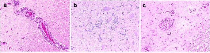Microscopic lesions detected in Pekin ducks experimentally infected with aquatic bird bornavirus 1 (ABBV-1) via intracranial (IC), intramuscular (IM), and choanal (CH) routes at 12 weeks postinfection.