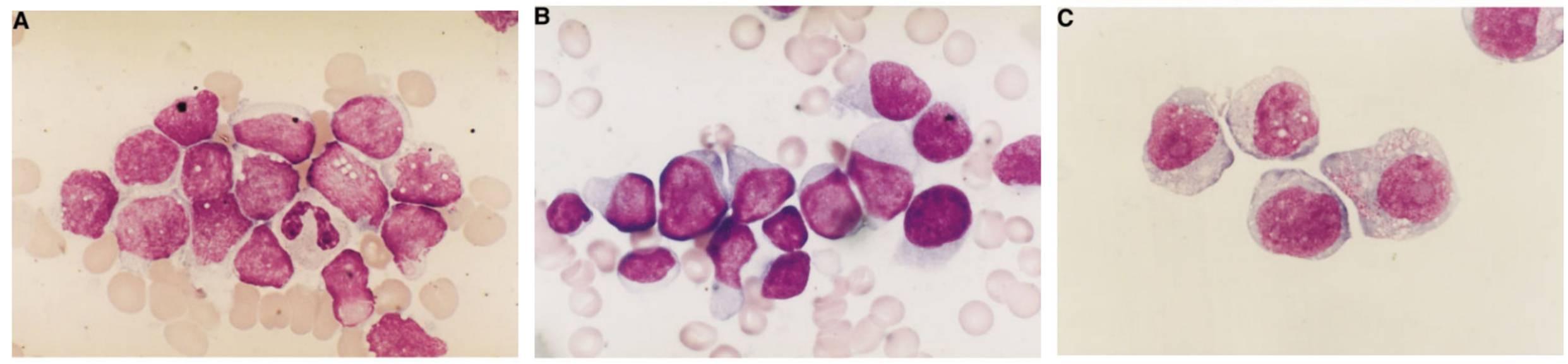 Fig. 1 Morphology of the (A) original leukemic cells, (B) relapsed leukemic cells and (C) Kasumi-6 cells. (Asou H, et al., 2003)