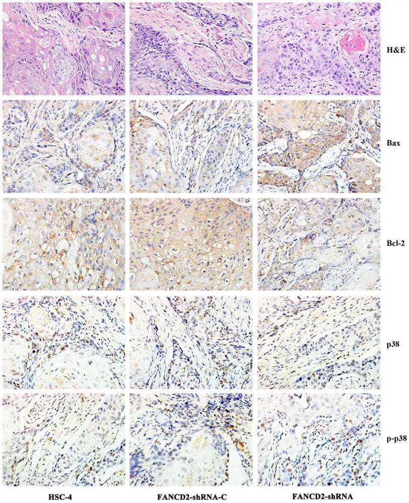 Conventional histopathological H&E staining showed that the three groups of tumors demonstrated the characteristics of squamous cell carcinoma. Positive expression of Bax and Bcl2 was found in the cytoplasm, and positive expression of p38 was primarily found in the cytoplasm but also partly in the nucleus. Positive expression of p-p38 was observed only in the nucleus.
