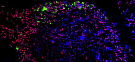 Astrocytoma/Glioblastoma cells