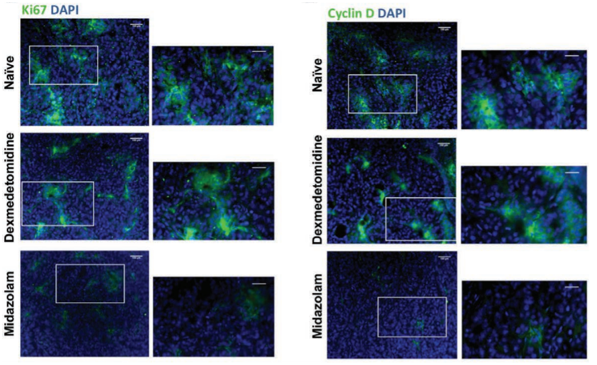 Representative images of immunofluorescence staining of Ki67 and cyclin D from tumor sections showed an increase in both proteins in dexmedetomidine-treated mice and a decrease in midazolam-treated mice.