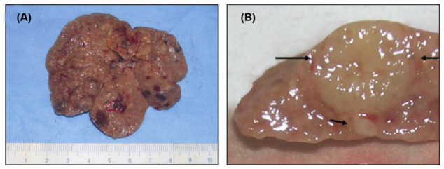 Chronic Liver Injury Models