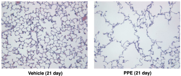 Chronic obstructive pulmonary disease (COPD) Models