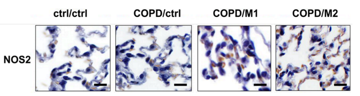 Chronic obstructive pulmonary disease (COPD) Models