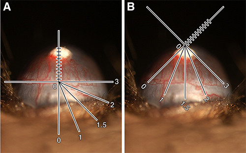 Quantification of corneal neovascularization