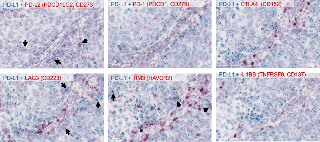 Co-expression Profiles of Immune Checkpoint Markers in Selected Tumors Using RNA ISH.