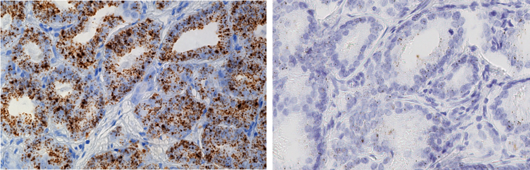 Urine tissue was stained with the Non-coding RNA-PCA3.