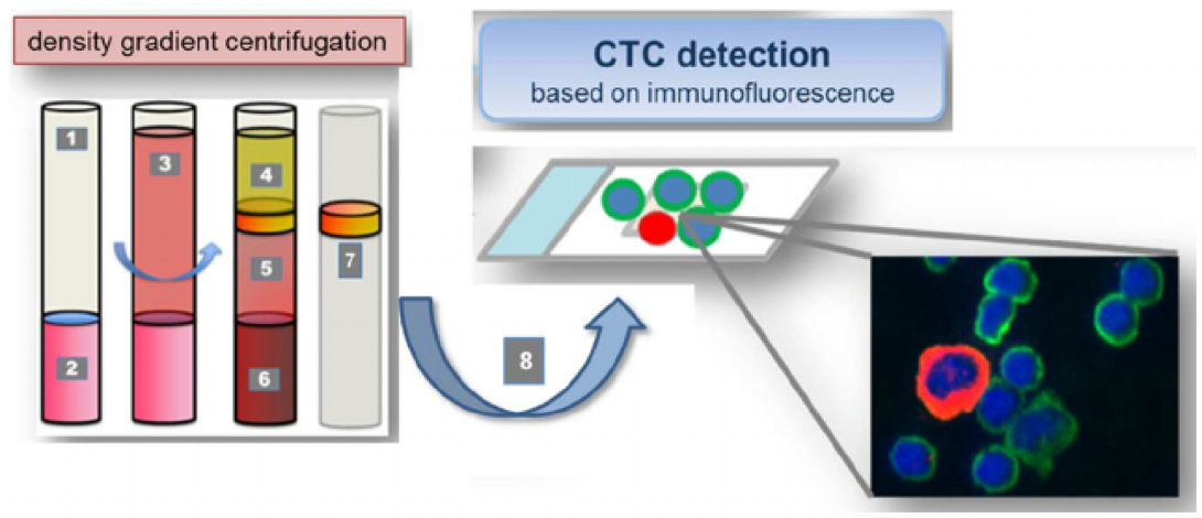 CTCs were isolated from peripheral venous blood using density gradient centrifugation. 1. Leucosep tube: 2. Separation media; 3. Whole blood/PBMNC mixture; 4. Plasma; 5. Separation media after centrifugation; 6. Erythocytes; 7. Buffy coat incl. CTCs; Cell suspension containing CTCs for Cellspin and multi-immunofluorescence staining. Cell suspensions were carefully spun onto glass slides. The presence of CTC was verified by immunofluorescence staining against pan-CK (epithelial), N-cadherin (mesenchymal), CD133 (stemcell-like); counterstaining with CD45 (hematopoietic) and DAPI (nucleus). (Weller, P. 2014)