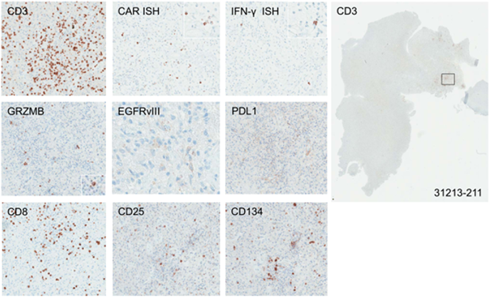 Multifocal CAR cell infiltrates associated with increased expression of IFN-γ, CD25 and CD134 and tumor cell EGFRvIII expression. Post EGFRvIII-CAR treatment biopsies of glipbalstoma multiforme (6 days).