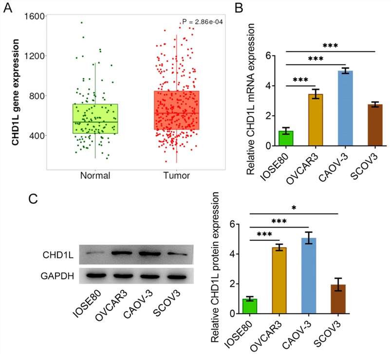 CHD1L expression in human ovarian cancer tissues and OC cell lines OVCAR3, CAOV-3 and SCOV3.