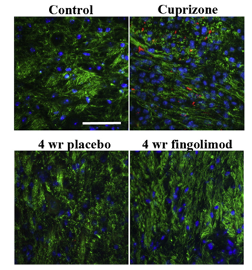 Subcortical β-APP (red) and neurofilament (green) staining of control, after 5 weeks of cuprizone exposure and after 4 weeks of recovery.