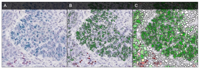 AN RNA ISH assay of a non-small-cell lung carcinoma, probed for the immune checkpoint markers PD-L1 (green) and CTLA4 (red) (A). Our system mark-up images are shown in (B) and (C) which visualize where the ISH module has detected probes (B) and where cells have been detected (C). Orange and red dots shown in (B) represent single and clusters of red probes, with the two shades of green dots representing the Expression of PDL-1 and T-lymphocytes identified by high levels of CTLA4 expression (red probe).
