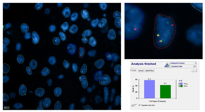 A DNA FISH assay for ALK translocation.