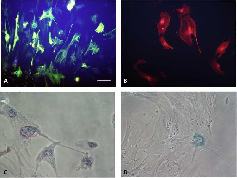 The Type of pancreatic stellate cells (PSCs). (A) Quiescent PSCs stain positively for desmin by IF. (B) Activated PSCs stain positively for α-SMA by IF. (C) Quiescent PSCs have an angular appearance, contained lipid droplets by oil red O staining. (D) Senescence is shown in PSCs with cytoplasmic blue staining of SA-β-gal.