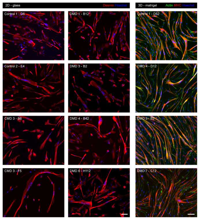 Derivation and Characterization of Immortalized Human Myogenic Cell Lines from Muscular Dystrophy Patients and Healthy Individuals.