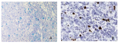 A. Rare IFNG expressing infiltrating CD3+ T cell in tumor microenvironment