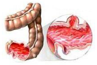 Colitis