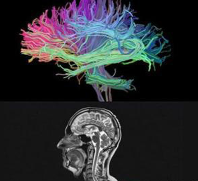 Multiple Sclerosis (MS) Models 